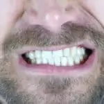 man grinding his teeth
